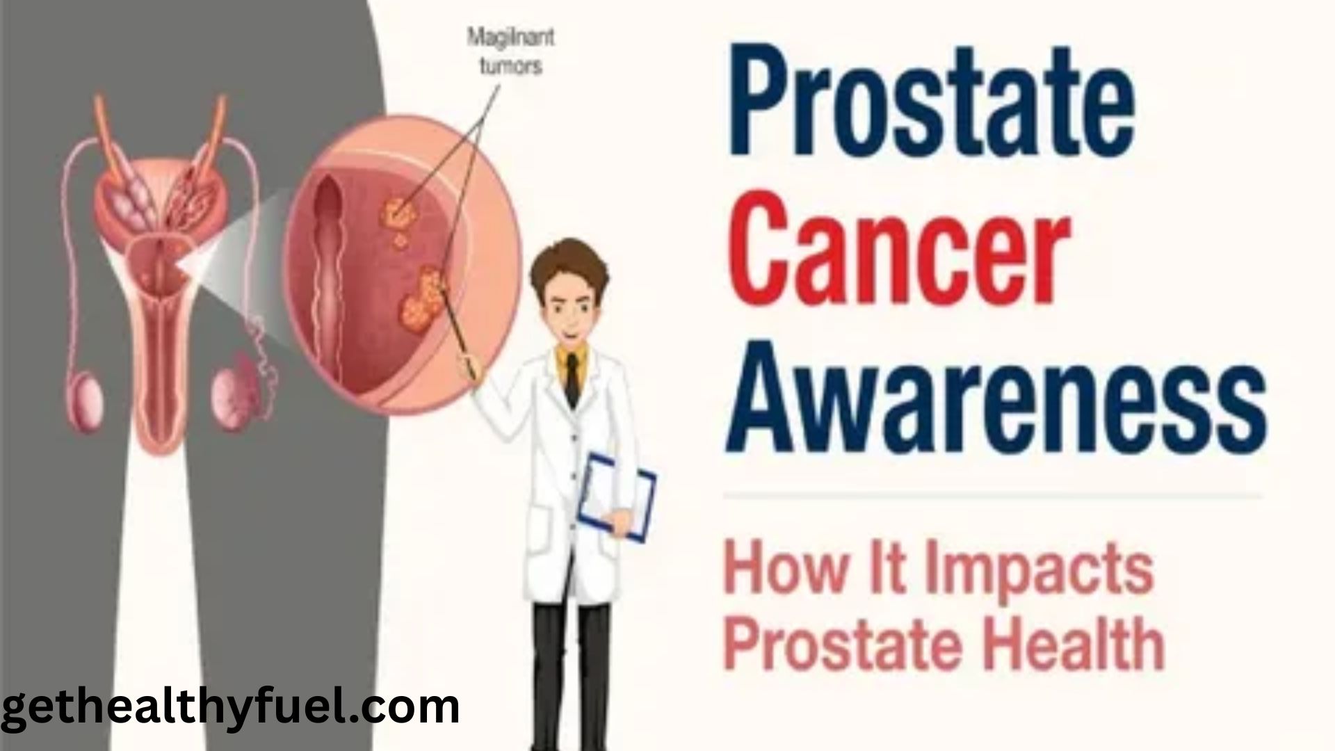 Benign Prostatic Hyperplasia (BPH)