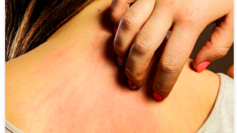 heat rashes